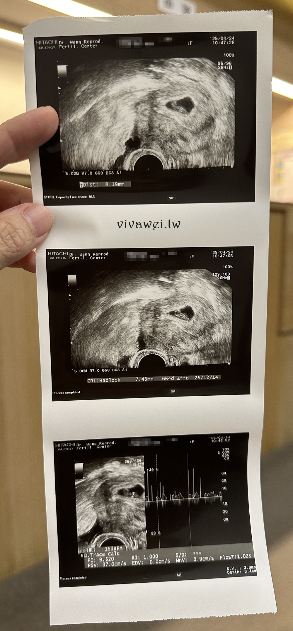 【王家瑋婦產科】相隔三年，我的試管IVF胚胎植入！植入一顆4BC等級PGS正常胚胎結果！