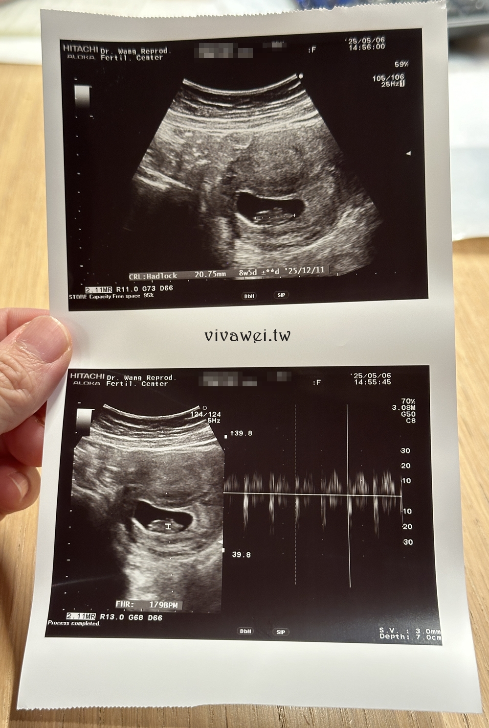 【王家瑋婦產科】相隔三年，我的試管IVF胚胎植入！植入一顆4BC等級PGS正常胚胎結果！