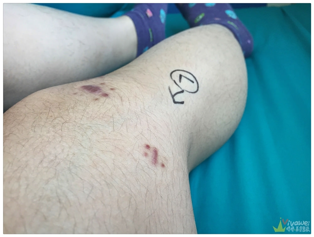 大腿骨折癒合不良需要第二次手術-苗栗弘大醫院骨科開刀&單人病房住院紀錄