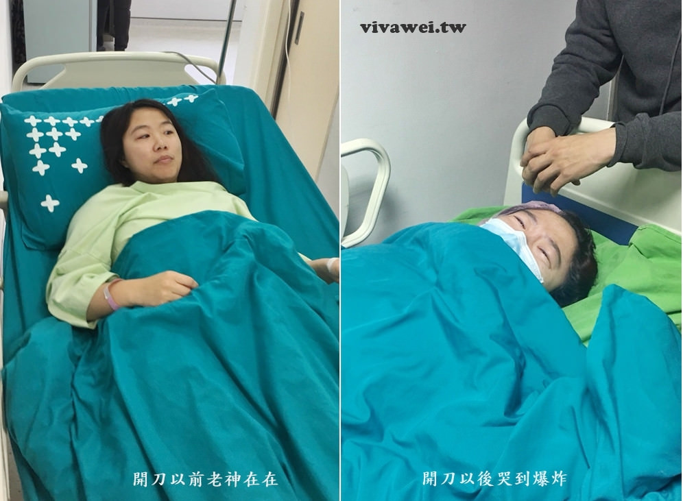大腿骨折癒合不良需要第二次手術-苗栗弘大醫院骨科開刀&單人病房住院紀錄