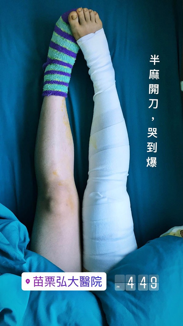 大腿骨折癒合不良需要第二次手術-苗栗弘大醫院骨科開刀&單人病房住院紀錄