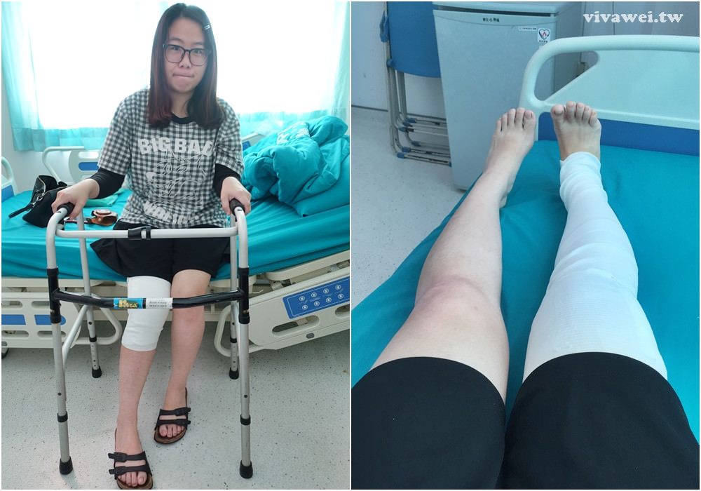 大腿骨折癒合不良需要第二次手術-苗栗弘大醫院骨科開刀&單人病房住院紀錄