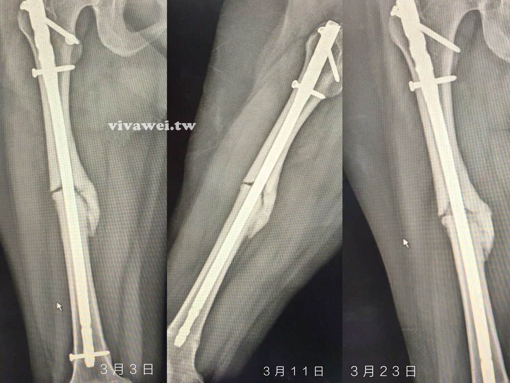 大腿骨折癒合不良需要第二次手術-苗栗弘大醫院骨科開刀&單人病房住院紀錄