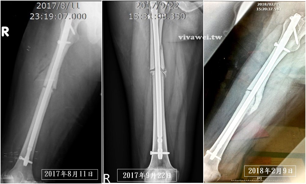 大腿骨折癒合不良需要第二次手術-苗栗弘大醫院骨科開刀&單人病房住院紀錄