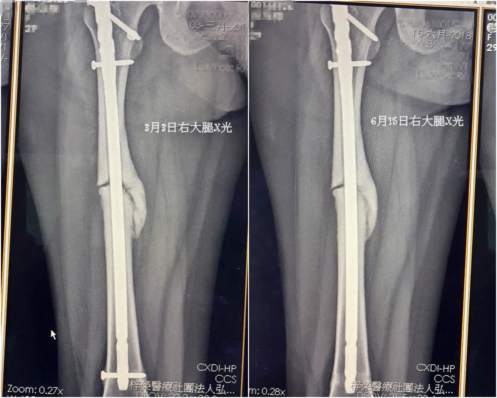 大腿骨折癒合不良需要第二次手術-苗栗弘大醫院骨科開刀&單人病房住院紀錄