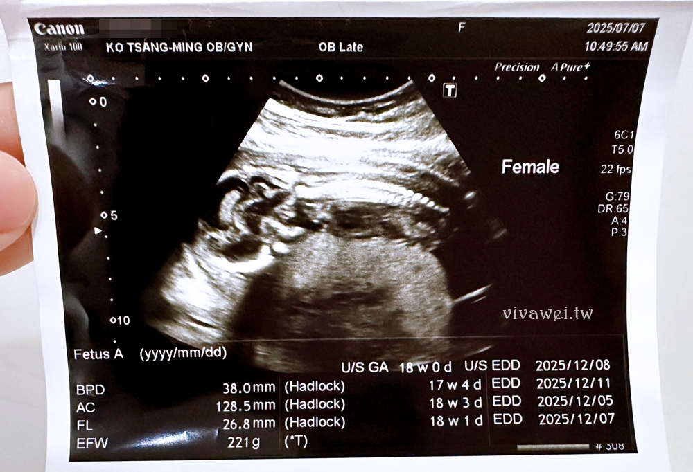 【柯滄銘婦產科診所】懷孕17週．2025年羊膜穿刺+羊水晶片檢查（檢查費用&報告等多久）