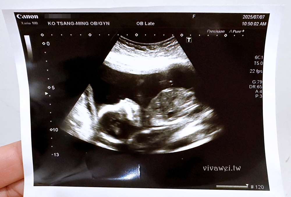 【柯滄銘婦產科診所】懷孕17週．2025年羊膜穿刺+羊水晶片檢查（檢查費用&報告等多久）