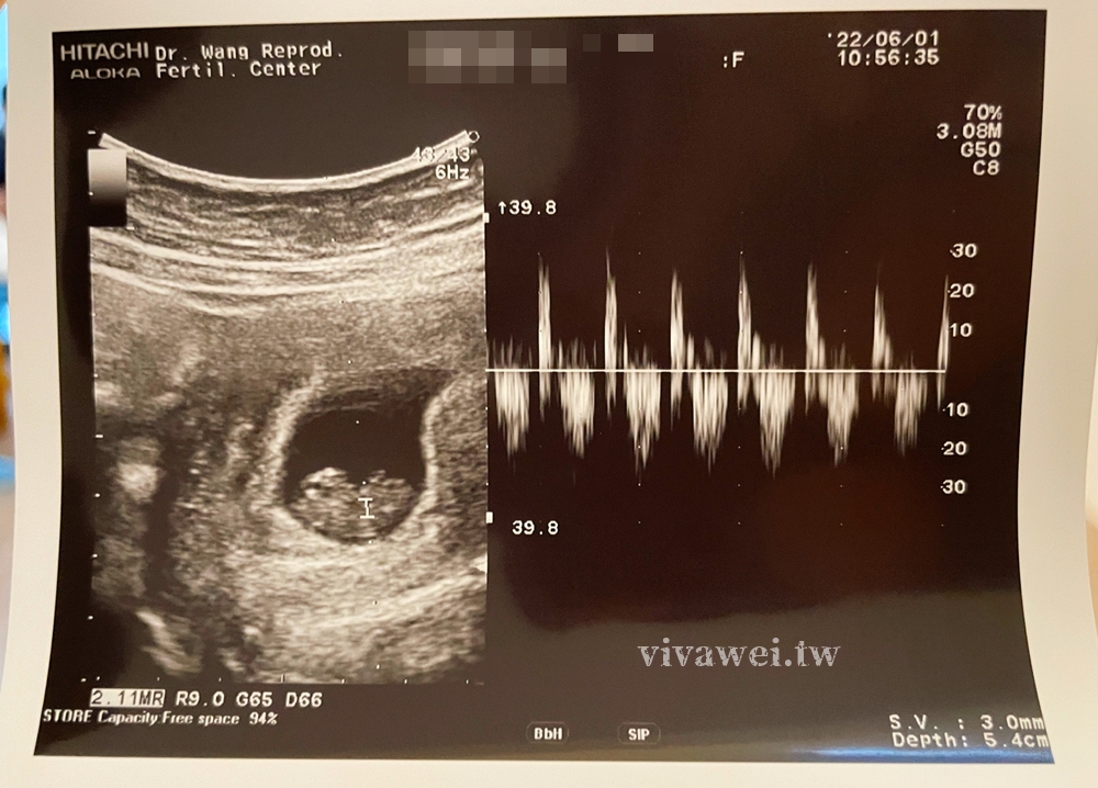 【王家瑋婦產科】我的第二次試管IVF，植入PGS正常胚胎，終於成功（植入後的身體變化）
