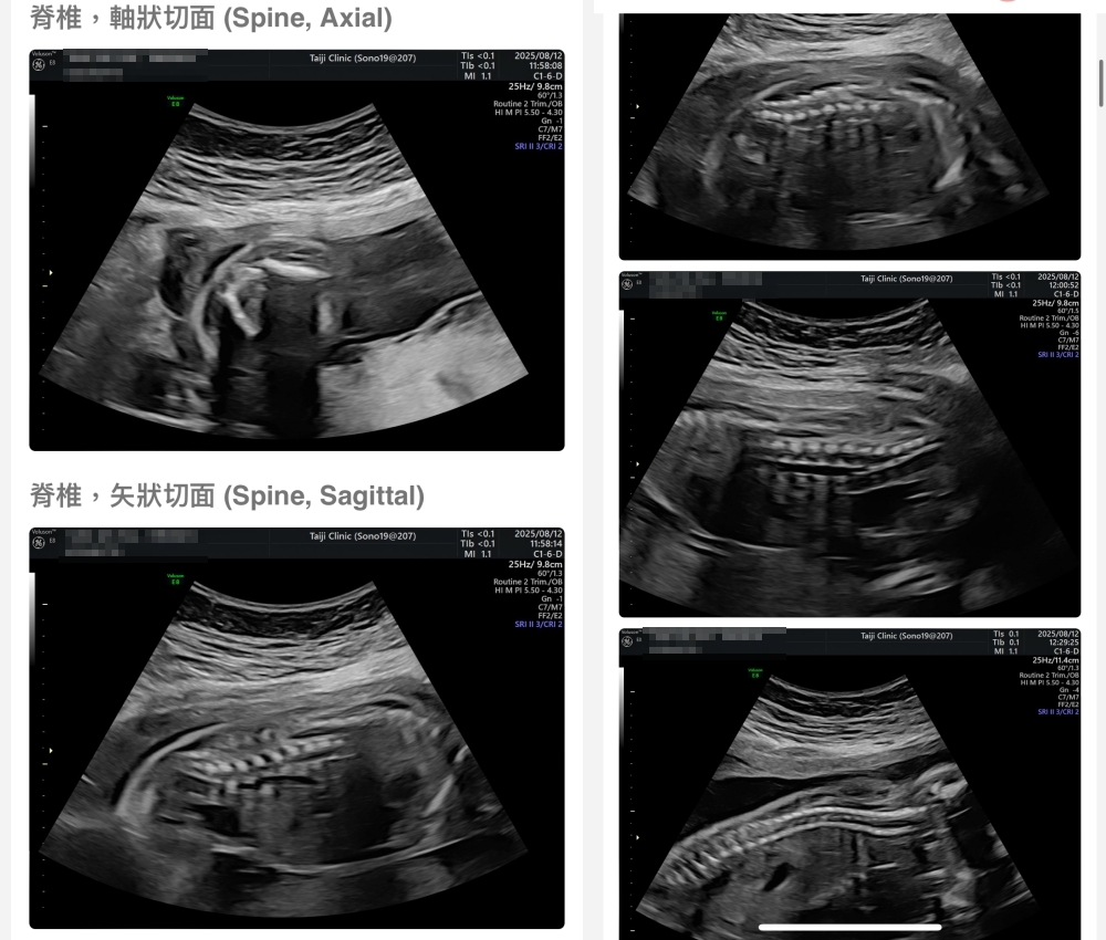 【新北新莊｜台兒醫療總部｜張東曜醫師】懷孕22-24週．中期胎檢．高層次超音波檢查（預約方式&檢查費用&檢查結果）