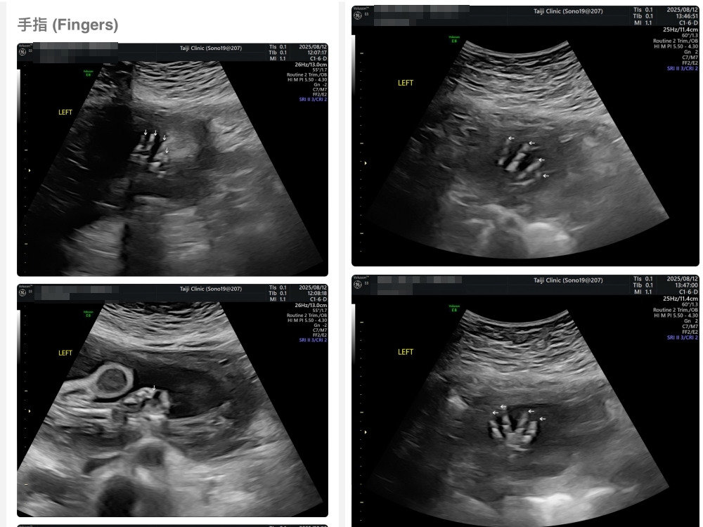 【新北新莊｜台兒醫療總部｜張東曜醫師】懷孕22-24週．中期胎檢．高層次超音波檢查（預約方式&檢查費用&檢查結果）