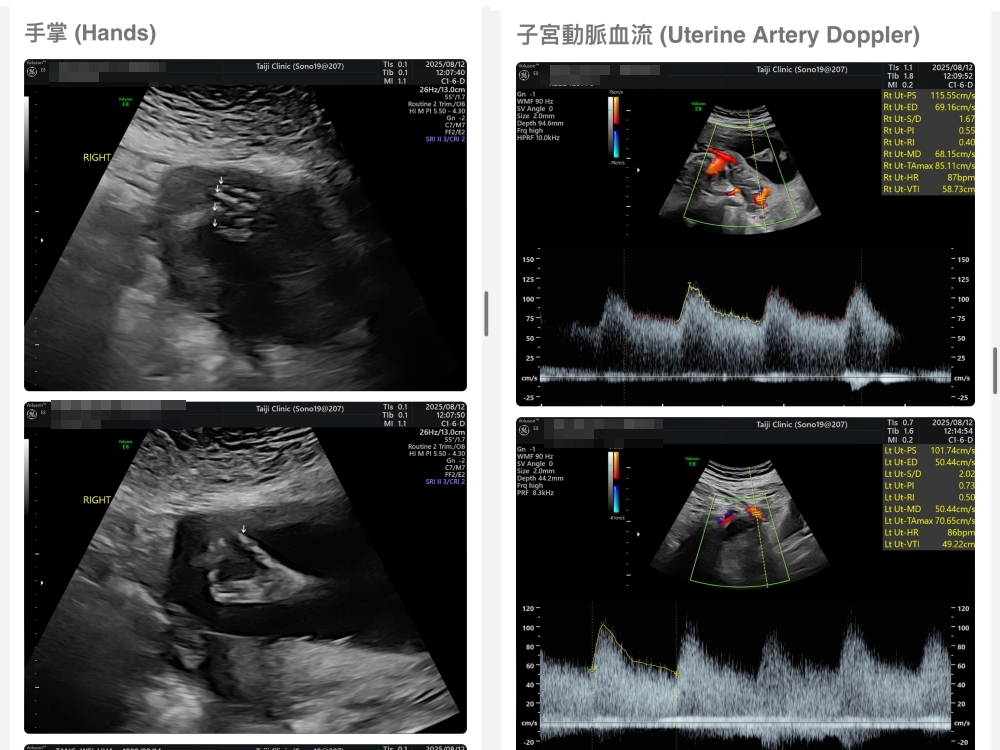 【新北新莊｜台兒醫療總部｜張東曜醫師】懷孕22-24週．中期胎檢．高層次超音波檢查（預約方式&檢查費用&檢查結果）