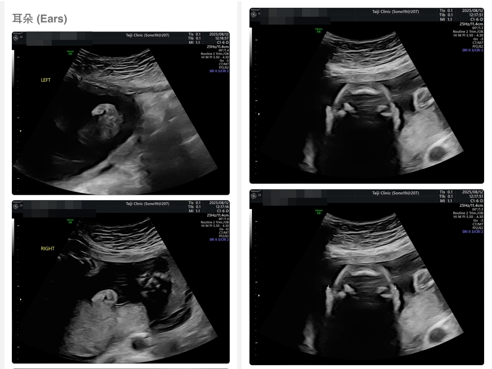 【新北新莊｜台兒醫療總部｜張東曜醫師】懷孕22-24週．中期胎檢．高層次超音波檢查（預約方式&檢查費用&檢查結果）