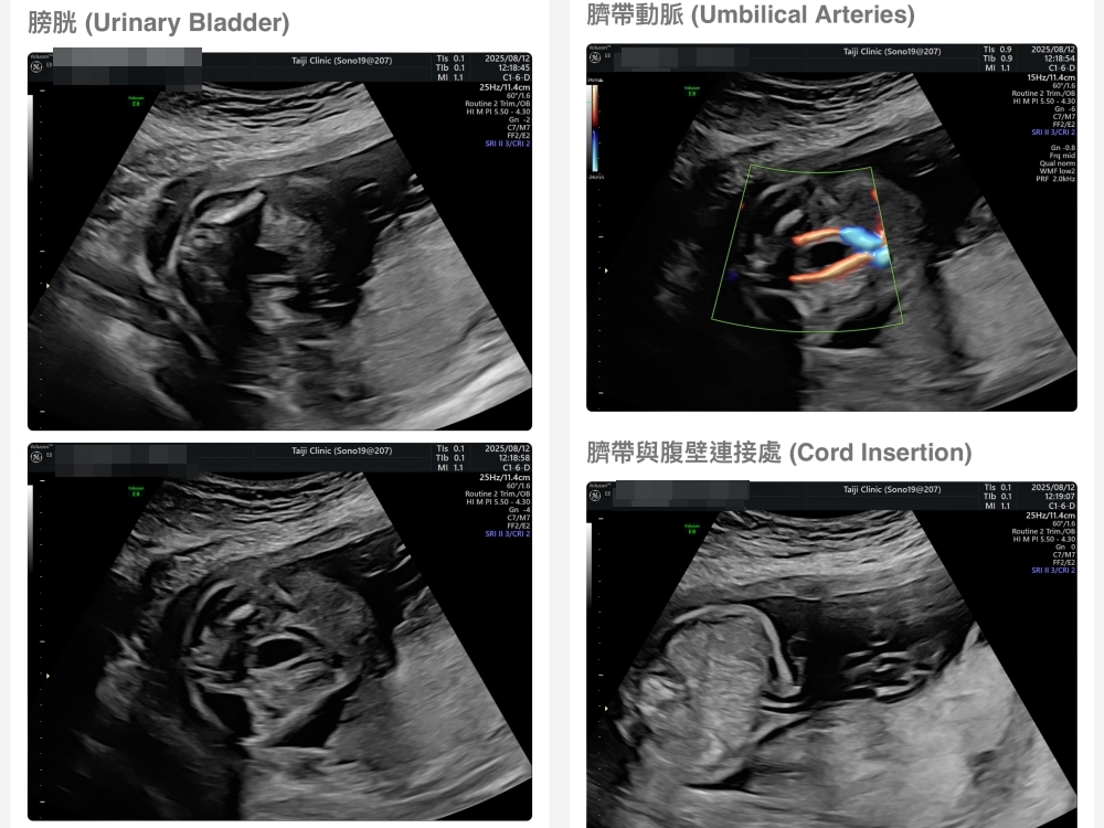 【新北新莊｜台兒醫療總部｜張東曜醫師】懷孕22-24週．中期胎檢．高層次超音波檢查（預約方式&檢查費用&檢查結果）
