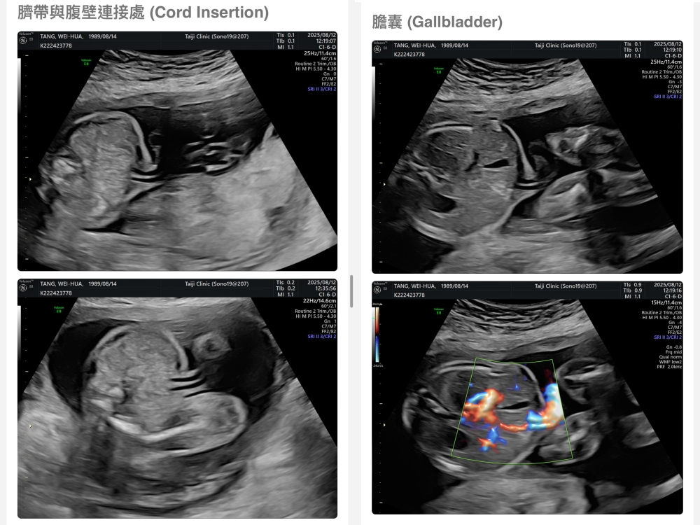 【新北新莊｜台兒醫療總部｜張東曜醫師】懷孕22-24週．中期胎檢．高層次超音波檢查（預約方式&檢查費用&檢查結果）