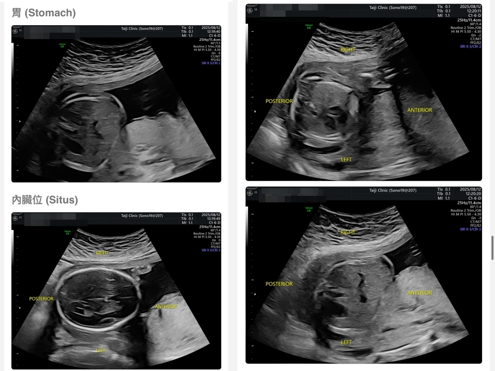 【新北新莊｜台兒醫療總部｜張東曜醫師】懷孕22-24週．中期胎檢．高層次超音波檢查（預約方式&檢查費用&檢查結果）
