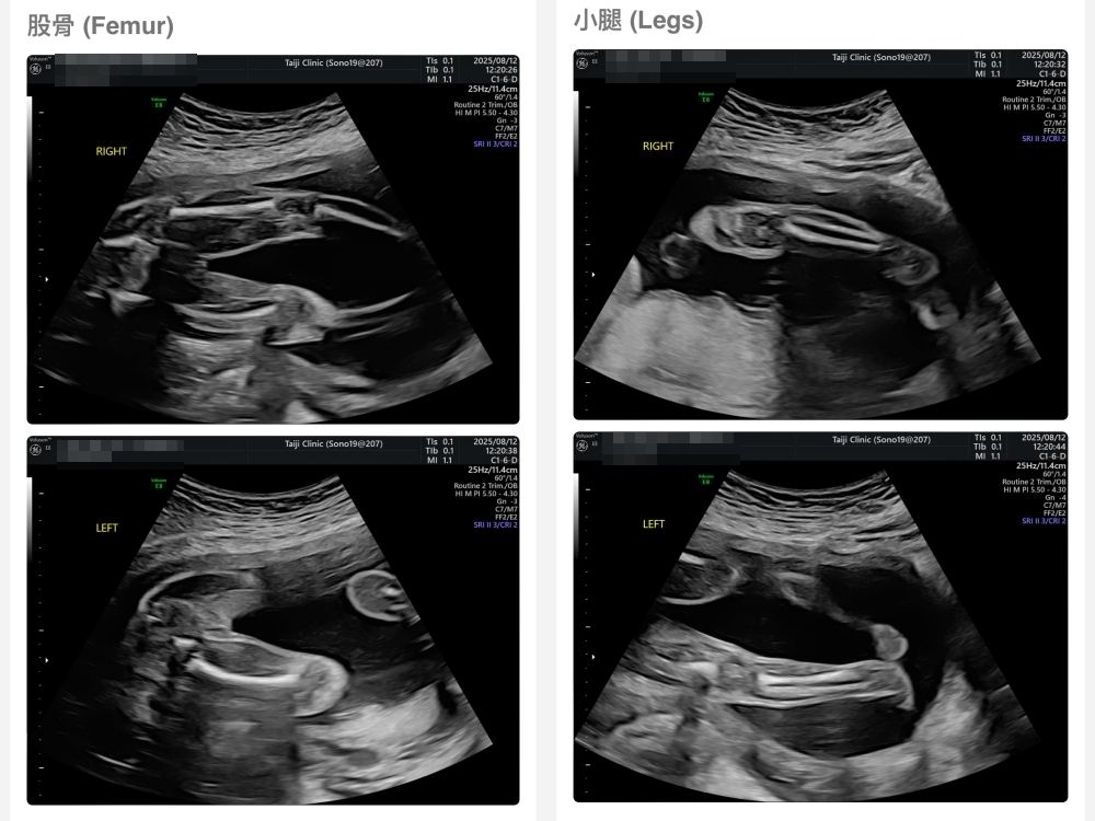 【新北新莊｜台兒醫療總部｜張東曜醫師】懷孕22-24週．中期胎檢．高層次超音波檢查（預約方式&檢查費用&檢查結果）