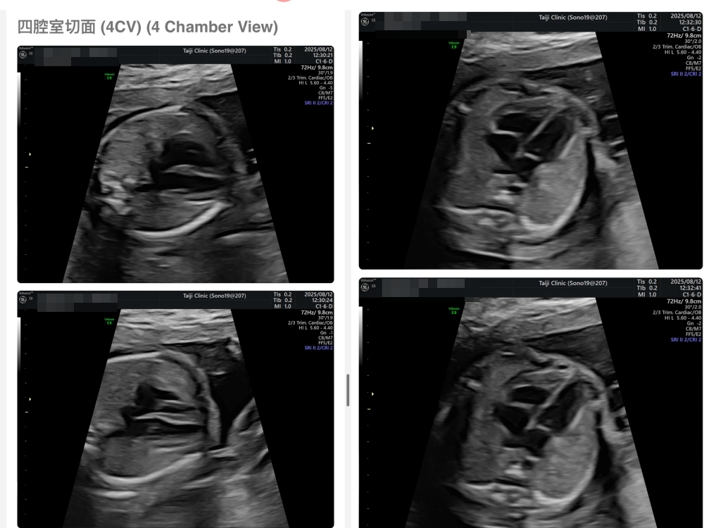 【新北新莊｜台兒醫療總部｜張東曜醫師】懷孕22-24週．中期胎檢．高層次超音波檢查（預約方式&檢查費用&檢查結果）