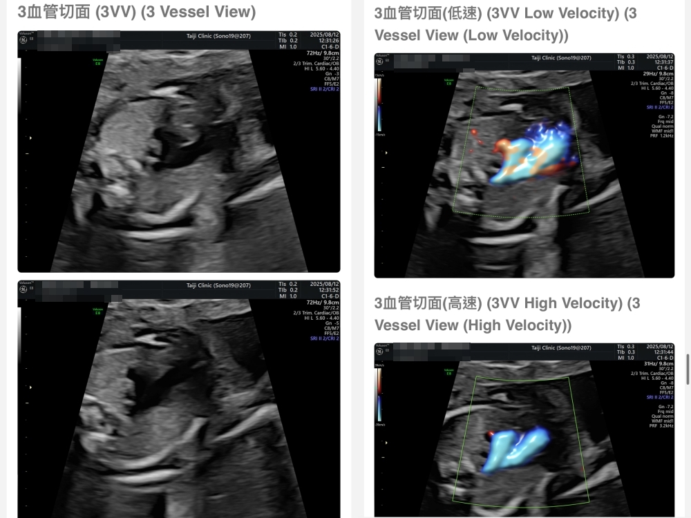 【新北新莊｜台兒醫療總部｜張東曜醫師】懷孕22-24週．中期胎檢．高層次超音波檢查（預約方式&檢查費用&檢查結果）