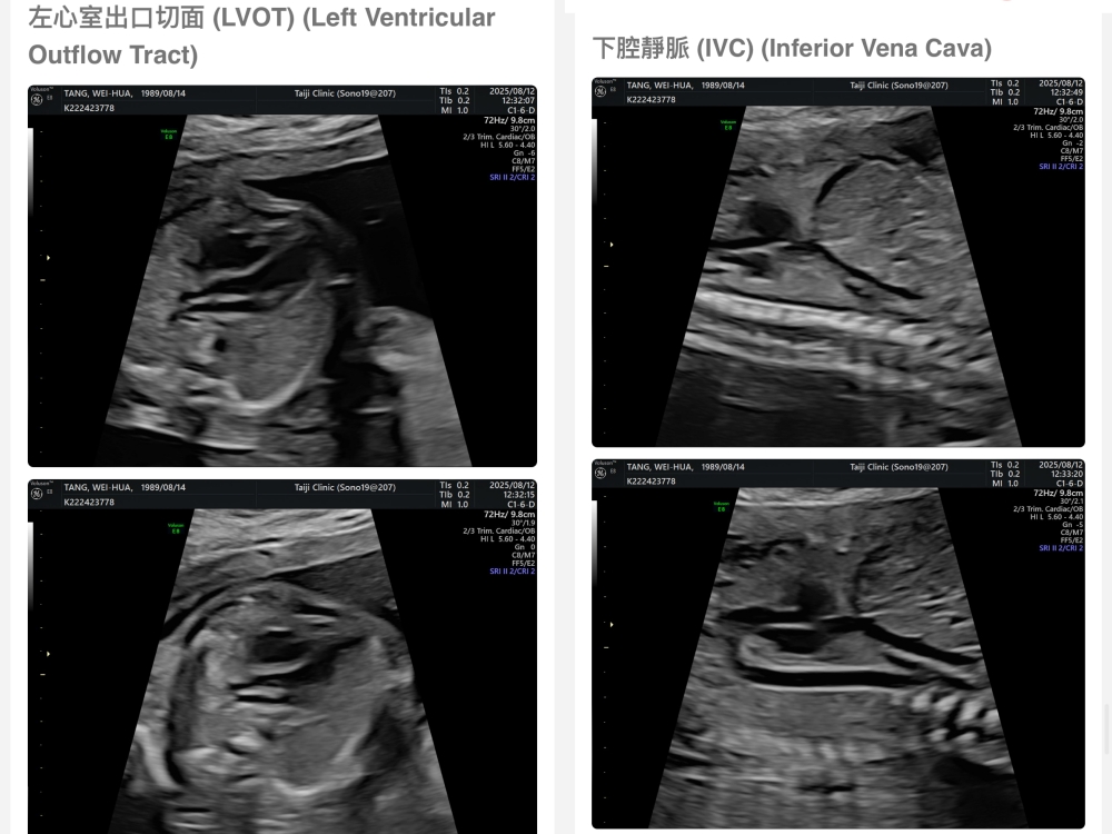 【新北新莊｜台兒醫療總部｜張東曜醫師】懷孕22-24週．中期胎檢．高層次超音波檢查（預約方式&檢查費用&檢查結果）