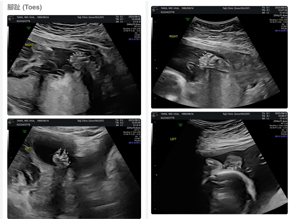 【新北新莊｜台兒醫療總部｜張東曜醫師】懷孕22-24週．中期胎檢．高層次超音波檢查（預約方式&檢查費用&檢查結果）