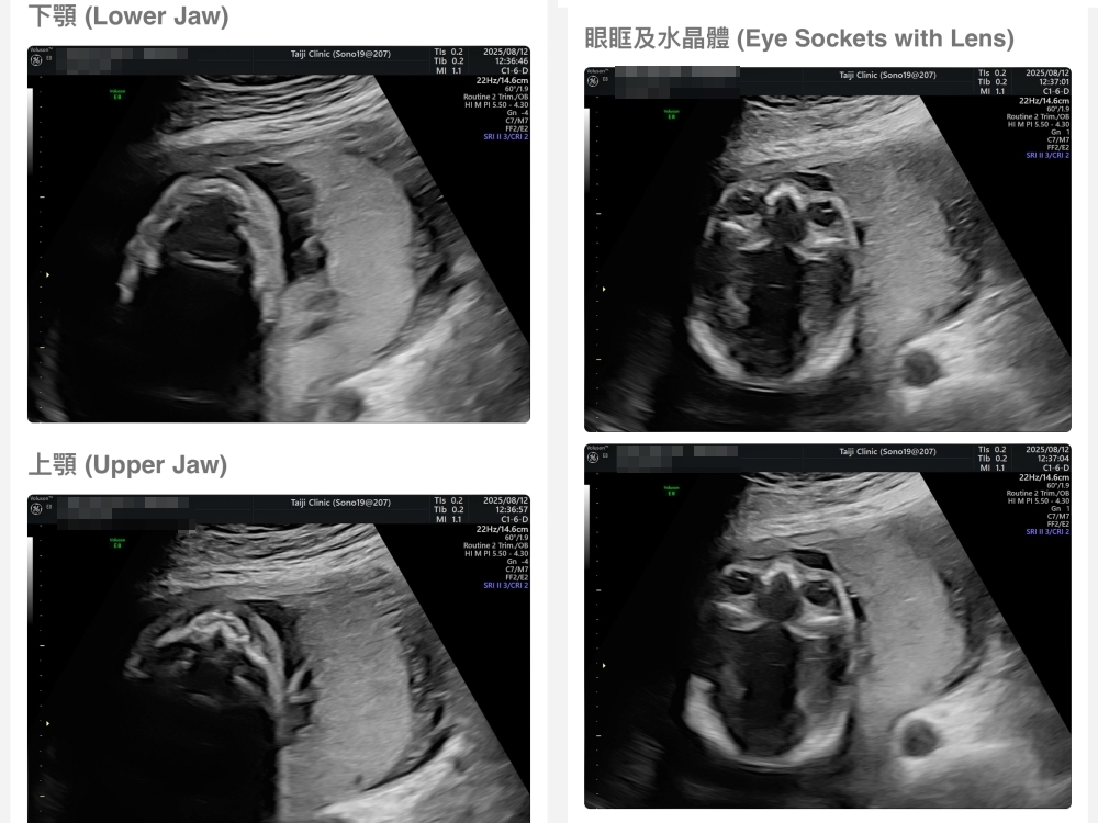 【新北新莊｜台兒醫療總部｜張東曜醫師】懷孕22-24週．中期胎檢．高層次超音波檢查（預約方式&檢查費用&檢查結果）