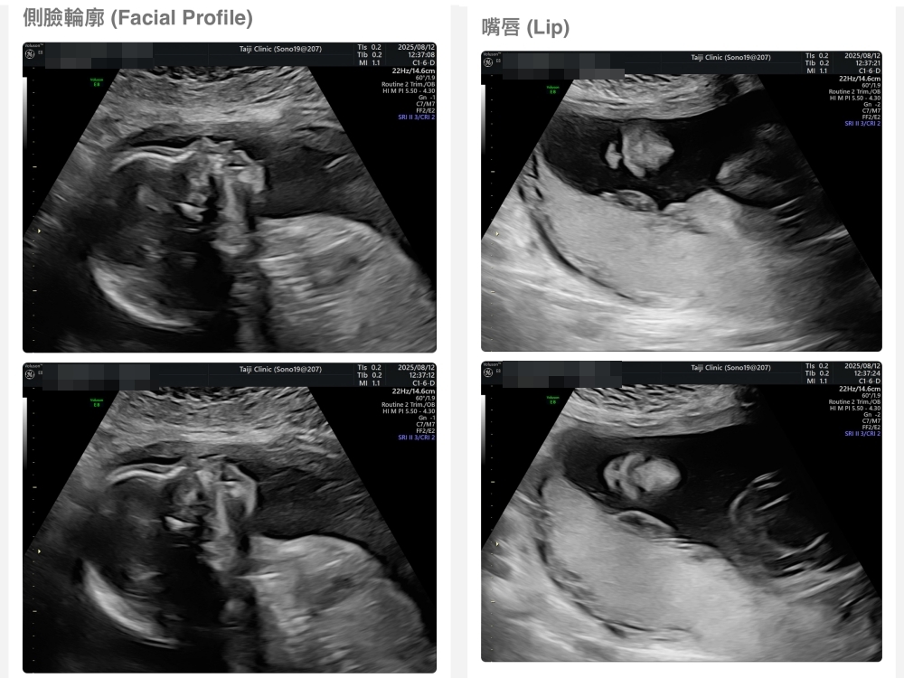 【新北新莊｜台兒醫療總部｜張東曜醫師】懷孕22-24週．中期胎檢．高層次超音波檢查（預約方式&檢查費用&檢查結果）