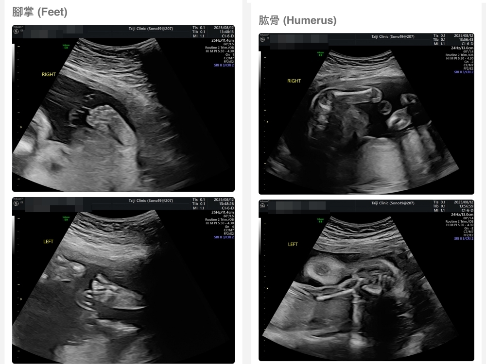 【新北新莊|台兒醫療總部|張東曜醫師】懷孕22-24週.中期胎檢.高層次超音波檢查(預約方式&檢查費用&檢查結果) 【新北新莊|台兒醫療總部|張東曜醫師】懷孕22-24週.中期胎檢.高層次超音波檢查(預約方式&檢查費用&檢查結果)