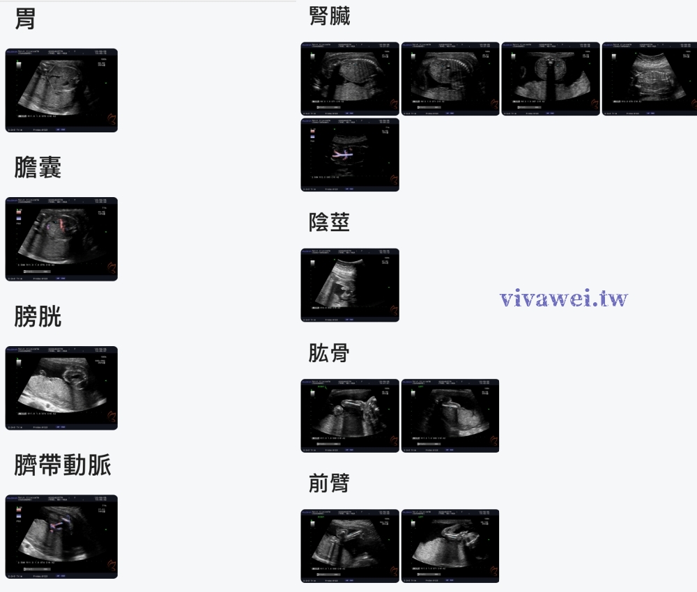 【台兒診所－林丹薇醫師】懷孕22週．高層次超音波檢查（預約方式&檢查費用）
